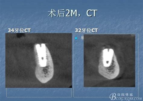 韩国登腾种植牙多少钱一颗？Dentium是几级钛后期稳定性怎么样_皓齿口腔网