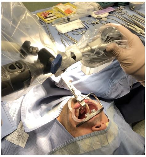JCM | Free Full-Text | Multi-Level 3D Surgery for Obstructive Sleep Apnea: Could It Be the Future?