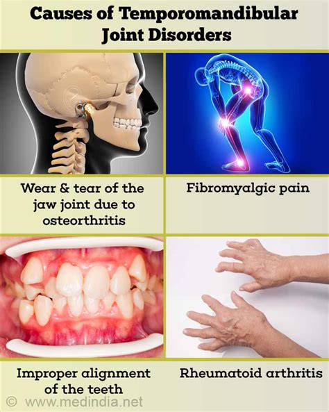 Temporomandibular Joint Disorders - Causes, Symptoms, Diagnosis & Treatment