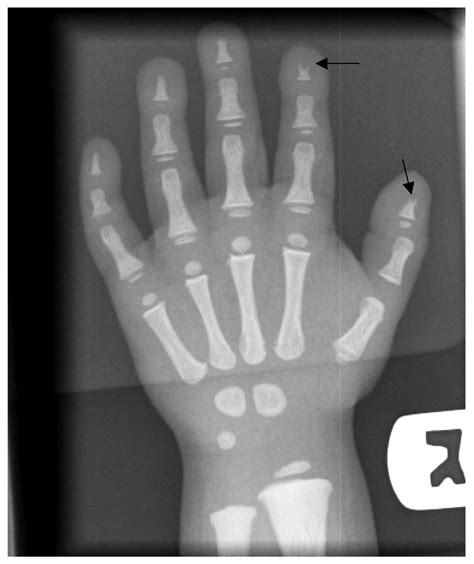 Toulouse-Lautrec syndrome | pacs