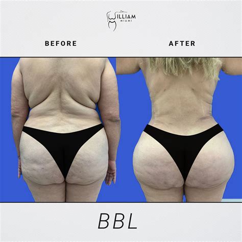 Before & After - Dr. William Miami