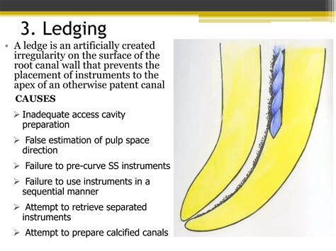 Cleaning and Shaping of Root Canal Systems | PPTX