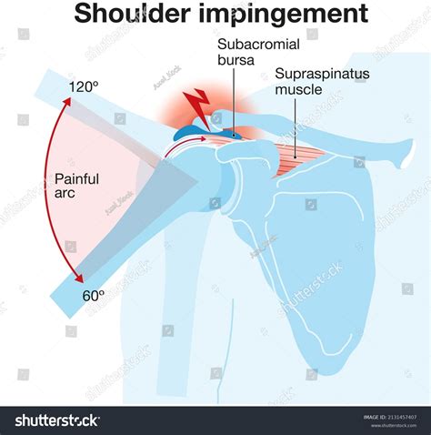 Illustration Showing Shoulder Anatomy Rotator Cuff Stock Illustration 2131457407