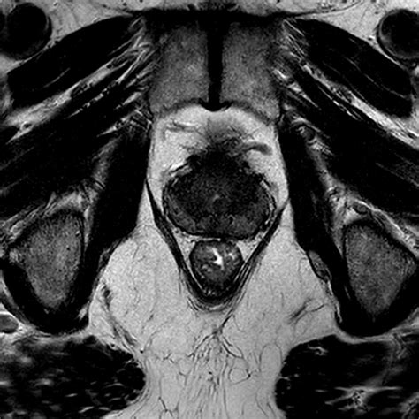 Multiparametric MR Imaging of the Prostate after Treatment of Prostate CancerRadioGraphics