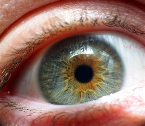 A new enzyme based treatment developed for severe dry eye disease