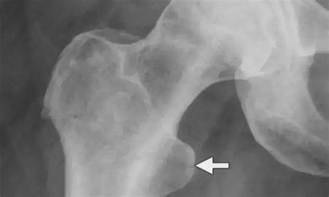 Rare case of Fat Embolism Syndrome with Multiple Small Pulmonary Emboli ...