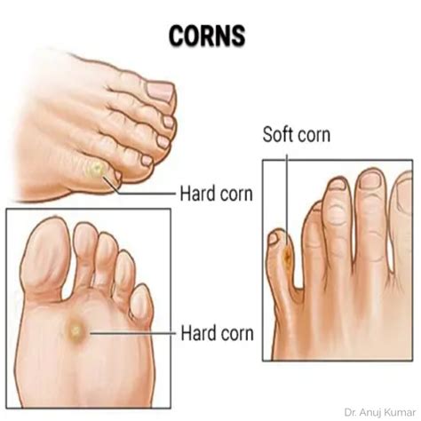 Foot Corns Treatment – Dr. Anuj Kumar