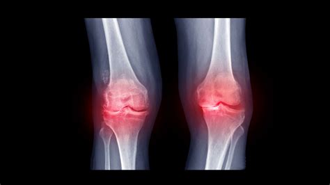 How Rheumatoid Arthritis Affects Each Part of the Body