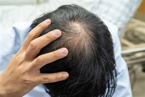 Hair Loss Treatment | Hair Loss and Thinning Treatment
