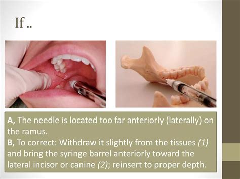 Mandibular Anesthesia : Inferior alveolar nerve block | PPTX