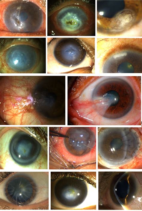 Cornea Transplant - LJ Eye Institute