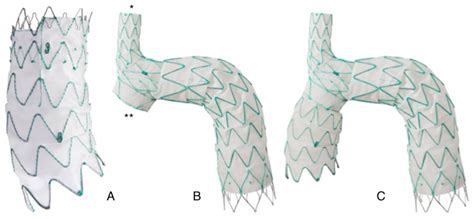 Total Endovascular Aortic Arch Repair: From Dream to Reality