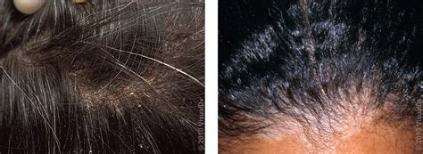 Eczema Hairline My Scalp Psoriasis Came Out Of Nowhere — Here's How