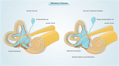 Meniere's Disease Pronunciation