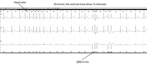 An Interesting Holter Strip | ECG Guru - Instructor Resources