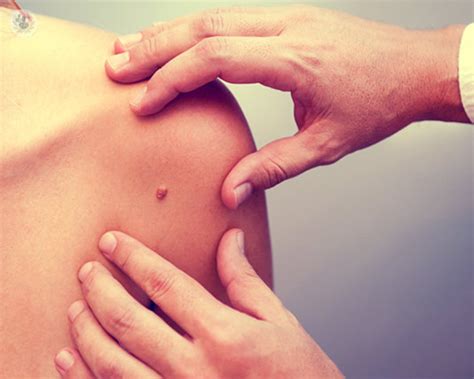 Image result for Cyst Extraction Videos