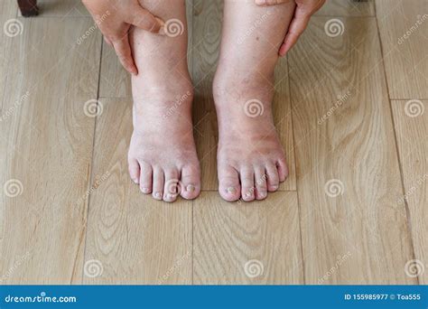 Senior Woman Swollen Feet and Leg Stock Image - Image of female, asia: 155985977