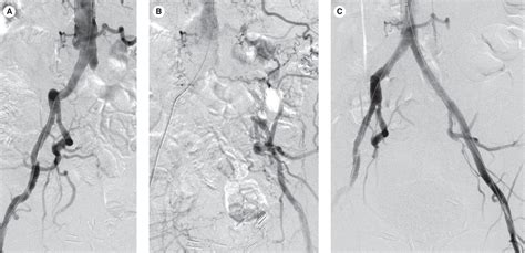 Aortoiliac Interventions for Occlusive Disease - Clinical Tree