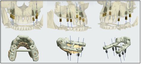 Digital Planning Technique for Surgical Guides for Prosthetic Implants ...