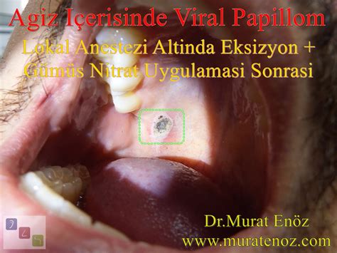 Oral Human Papillomavirus (HPV) Infection - Symptoms, Diagnosis ...