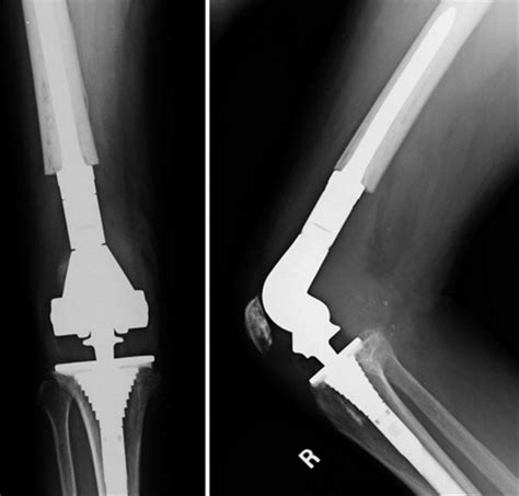 TKA Prosthesis Design - Recon - Orthobullets