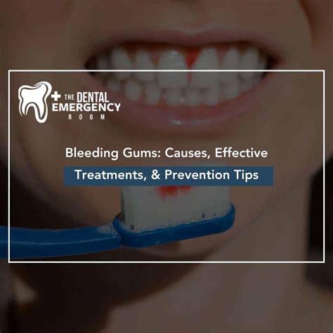 Bleeding Gums: Causes, Effective Treatments, & Prevention Tips
