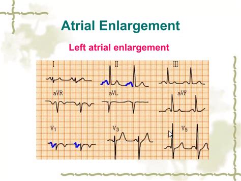 Left Atrial Enlargement Ecg