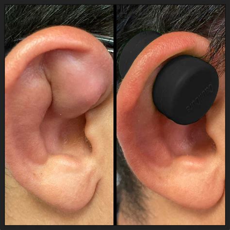Bildergebnis für cauliflower ear before and after