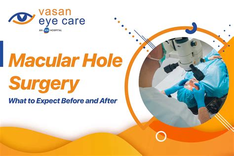 Macular Hole Surgery: Before & After Guide | Vasan Eye Care