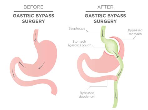 Gastric Bypass Surgery & Cost - The Surgical Weight Loss Centre