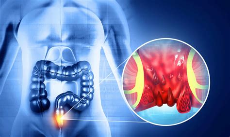 Hemorrhoid Diagnostic Testing - New England Endovascular Center