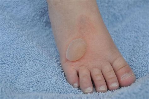 Foot Blisters On Bottom Of Foot Types Of Foot Blisters