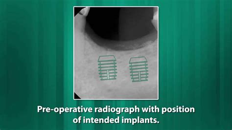 One-Stage Placement of Two Adjacent 4.5 x 6.0mm SHORT® Implants for ...