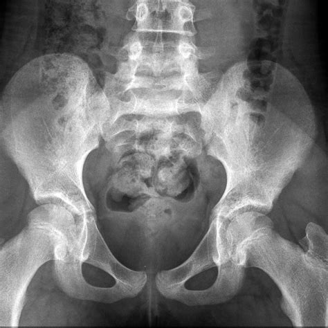 X Ray Pregnancy