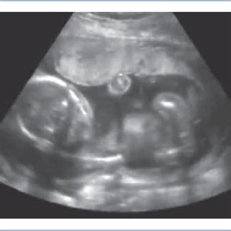 Ultrasound 的图像结果