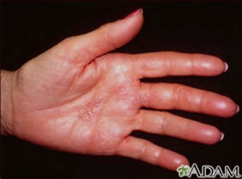 Herpes zoster (shingles) on the hand: MedlinePlus Medical Encyclopedia ...