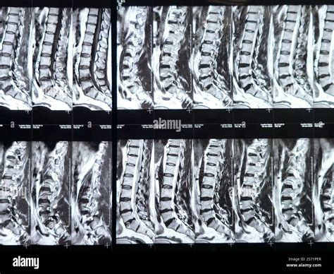 Magnetic Resonance Imaging MRI of the lumbosacral spine shows Spondylodegenerative changes of ...