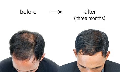 The Best Hair Loss Treatments for Men in Australia (2024)