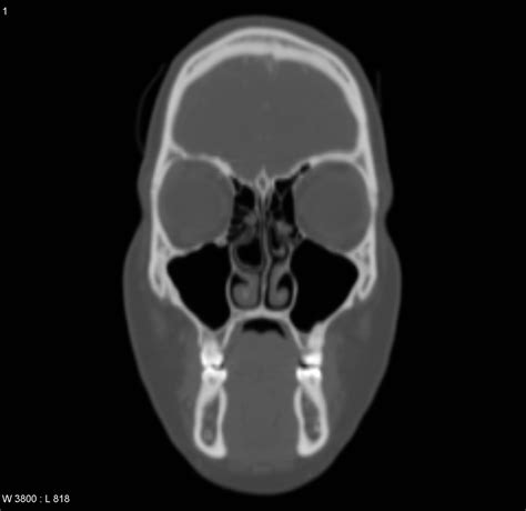 Unilateral Bulbous Concha Bullosa Download Scientific