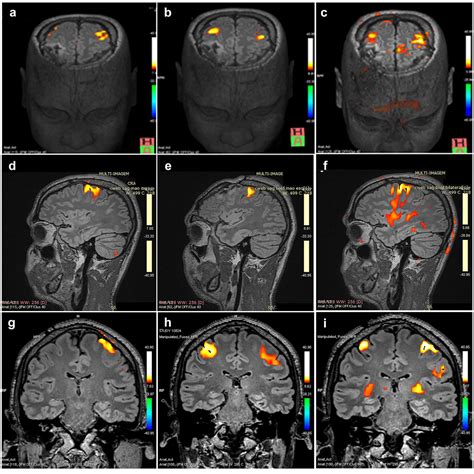 Phineas Gage Phineas Gage Poster Print – Noveltees