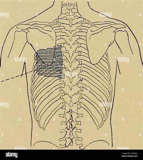 . Physical diagnosis . Pulmonic secondaccented. Systolic murmurloudest ...