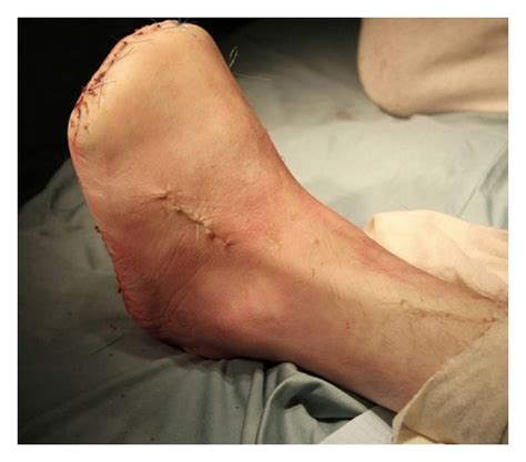 Transmetatarsal Amputation: A Case Series and Review of the Literature.