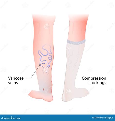 Compression Stockings for Varicose Veins Stock Vector - Illustration of education, female: 73894070