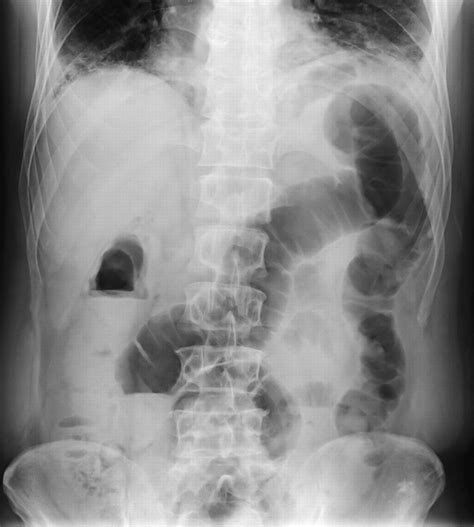 X Ray Of Severe Constipation Case Of A Woman With Severe Constipation