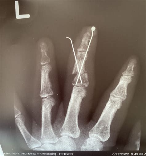 Xray Broken Finger