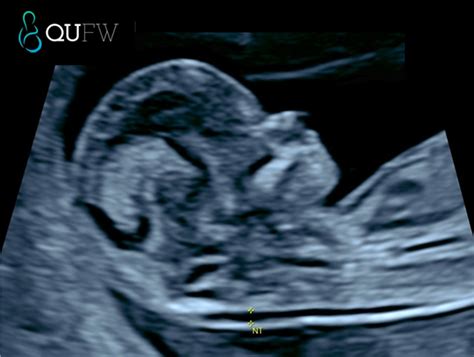 Nuchal Translucency Neck | Radiology Key
