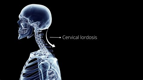 Straightened Cervical Lordosis