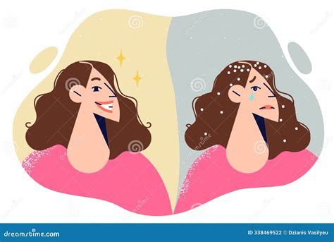 Dandruff Appeared in Woman Hair Due To Problems with Immune System or Use of Bad Shampoo Stock ...