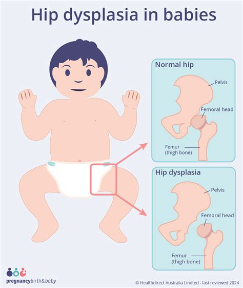 Hip dysplasia in babies | Pregnancy Birth and Baby
