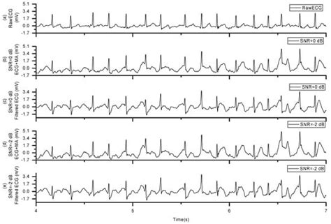 Artificial Intelligence-Based Atrial Fibrillation Recognition Method ...